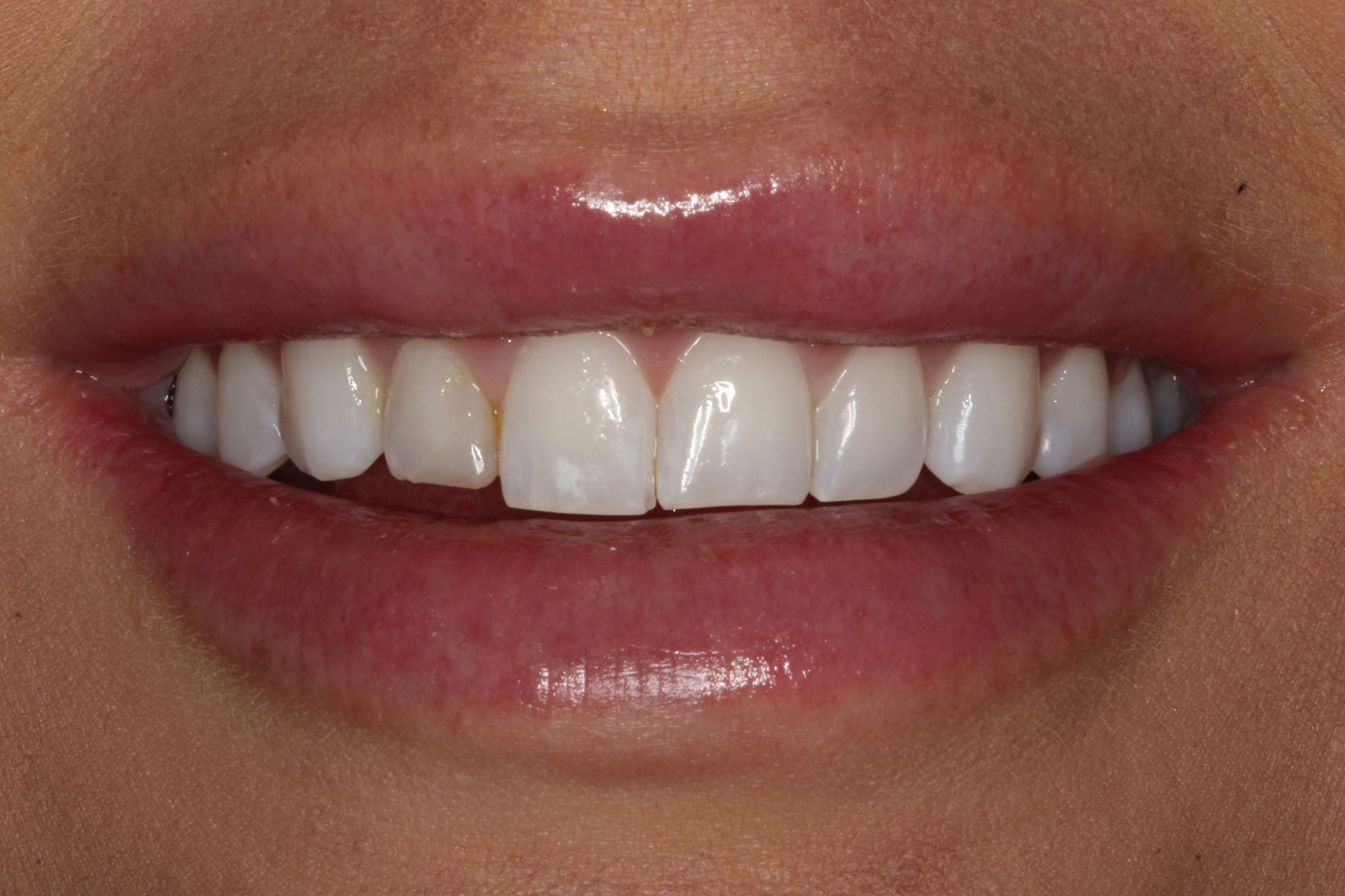 цвет зубов а3 фото у женщин